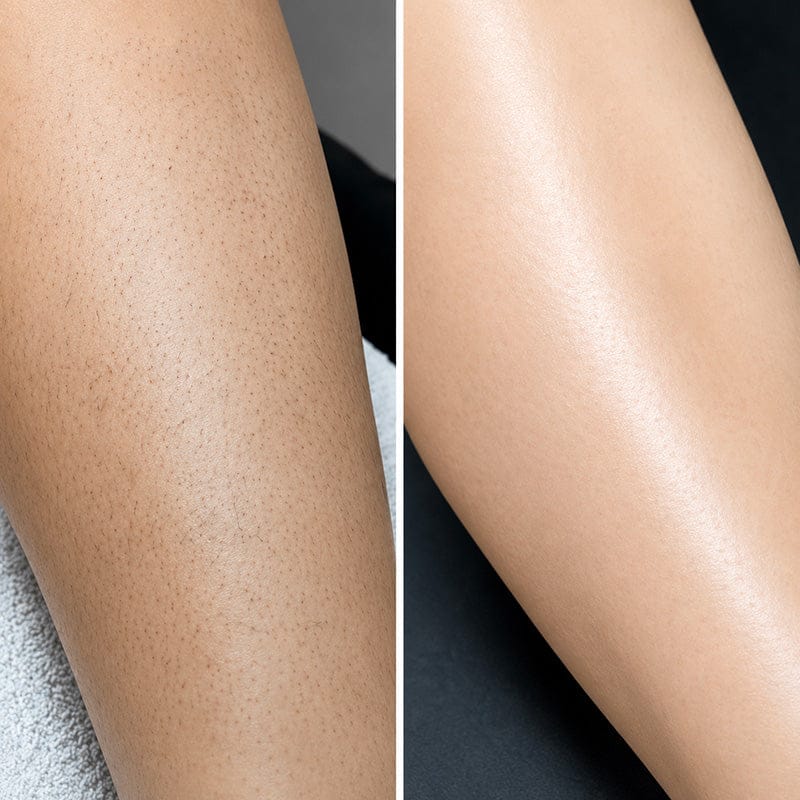 Customer photo review of SilkyLisse | Le Rasoir Féminin 2-en-1 Pour Zones Sensibles