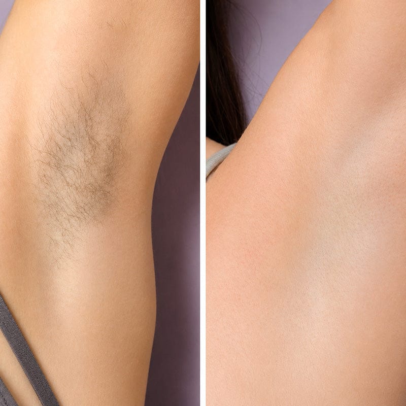Customer photo review of SilkyLisse | Le Rasoir Féminin 2-en-1 Pour Zones Sensibles