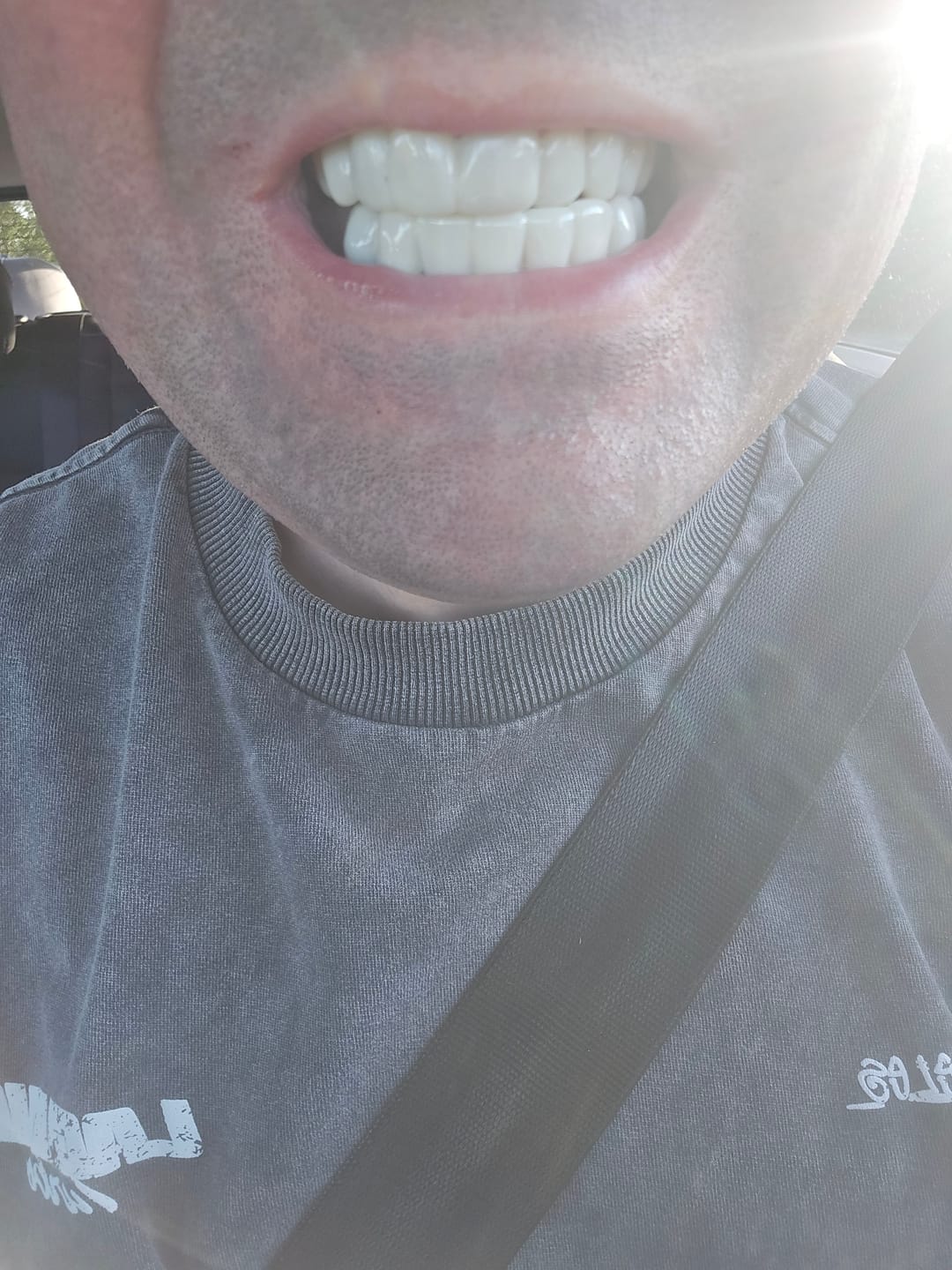 Customer photo review of Click-in Veneers 4.0