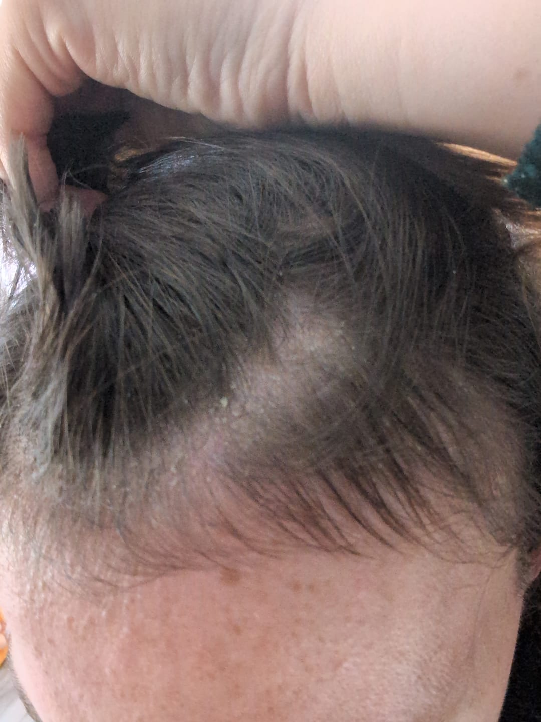 Customer photo review of SCALP HARMONY™ BOX – Für sensible Kopfhaut