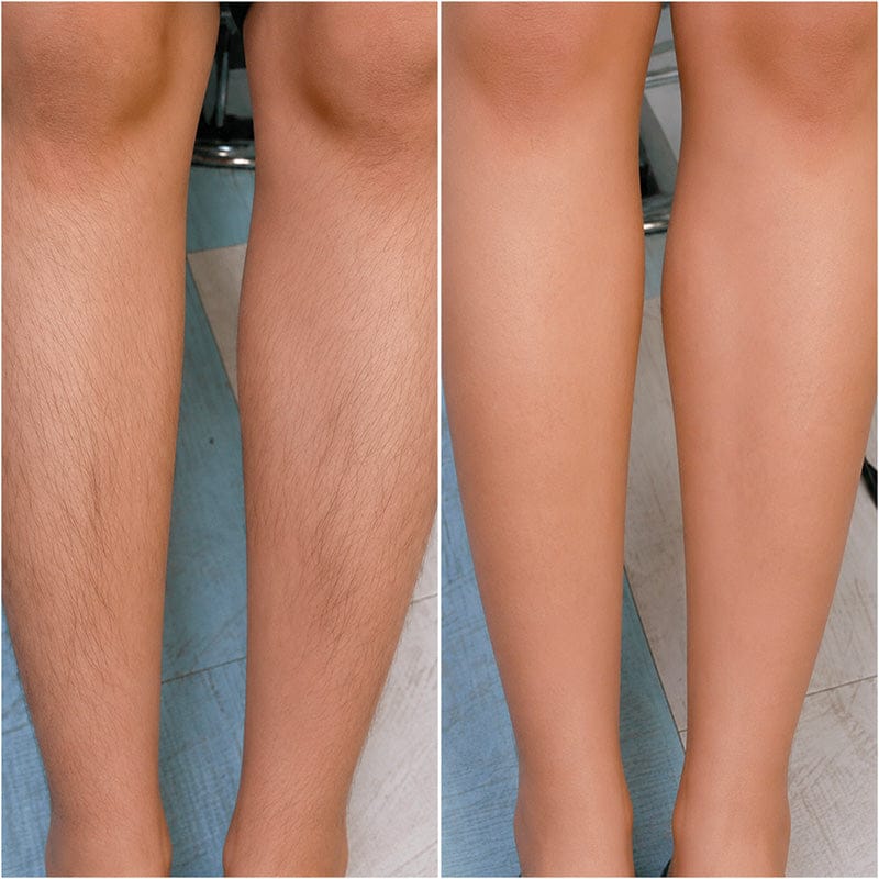 Customer photo review of SilkyLisse | Le Rasoir Féminin 2-en-1 Pour Zones Sensibles