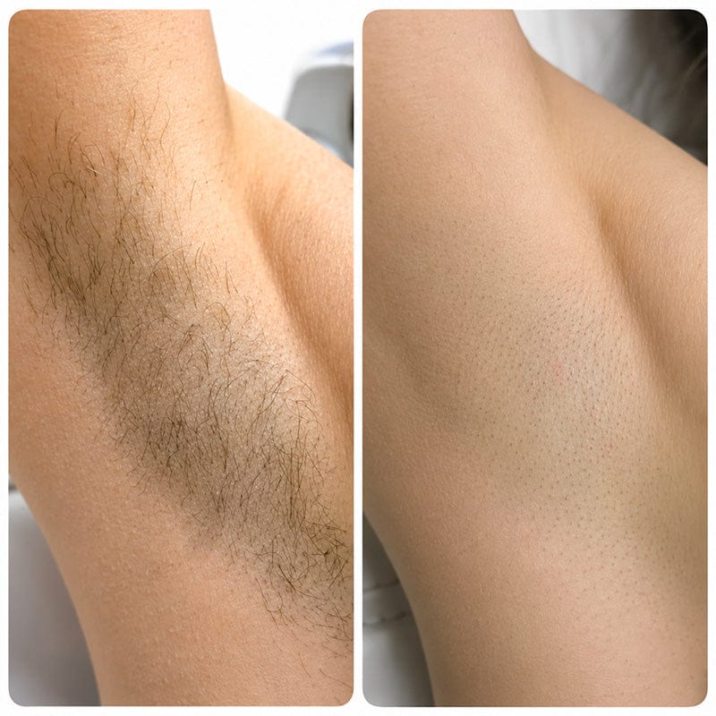 Customer photo review of SilkyLisse | Le Rasoir Féminin 2-en-1 Pour Zones Sensibles