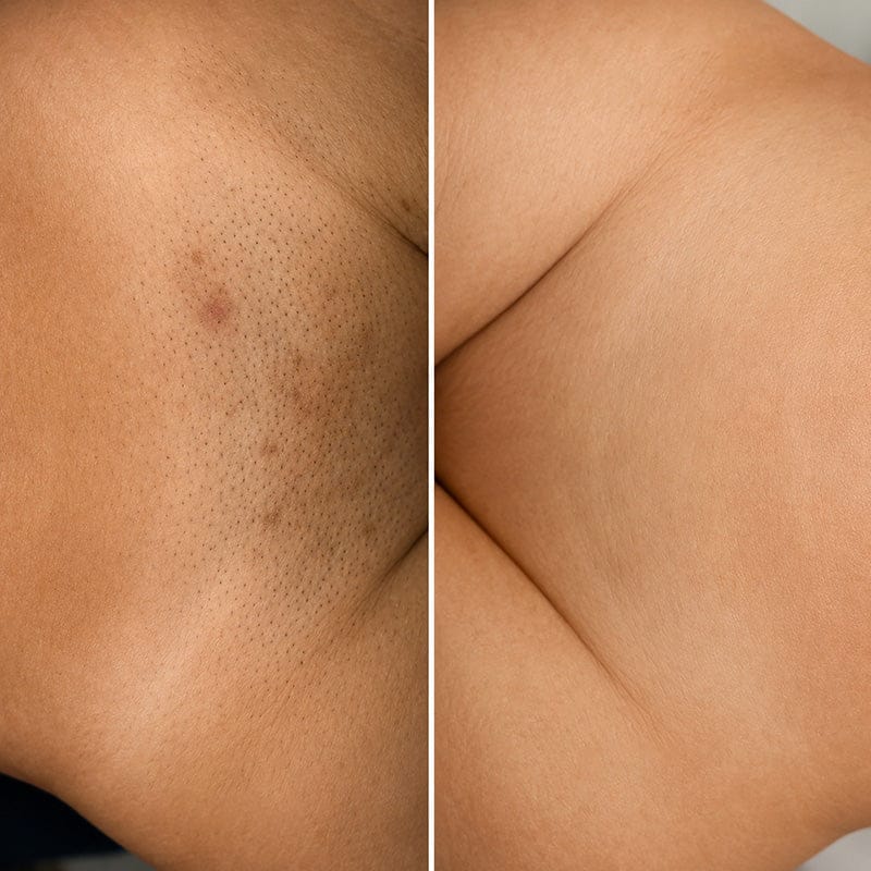 Customer photo review of SilkyLisse | Le Rasoir Féminin 2-en-1 Pour Zones Sensibles