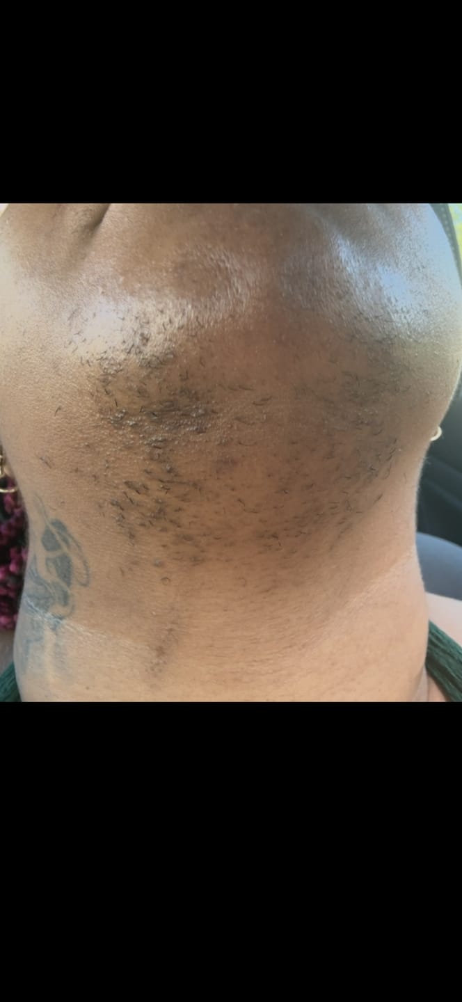 Customer photo review of Hair Reducing Fade Oil - Slows Growth, Thins, and Reduces Hair Naturally