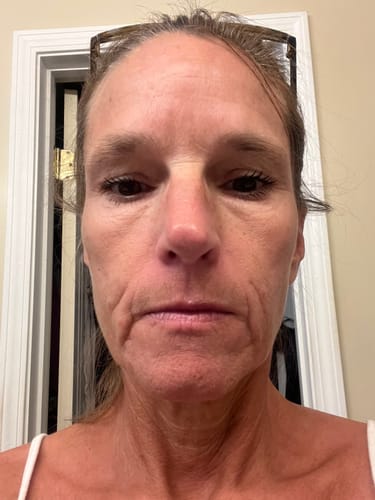 Customer's close-up showing facial skin texture and fine lines after using the Micro Infusion System.
