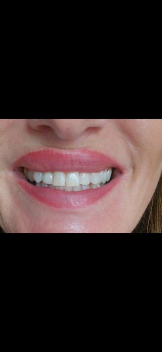 Customer photo review of Composite Care Bundle