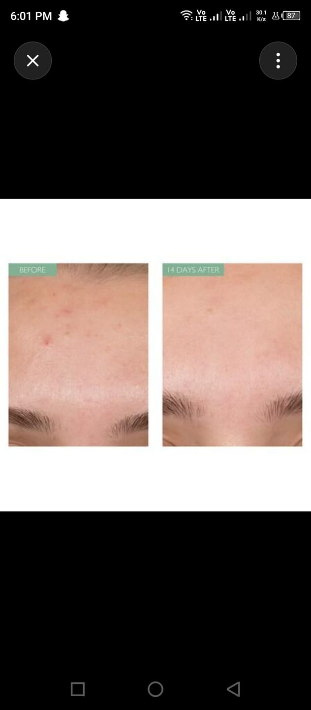 Customer photo review of Anti Acne Bundle