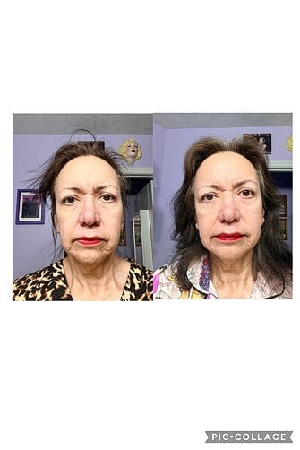 Customer photo review of Perfect Instant Face Tightener