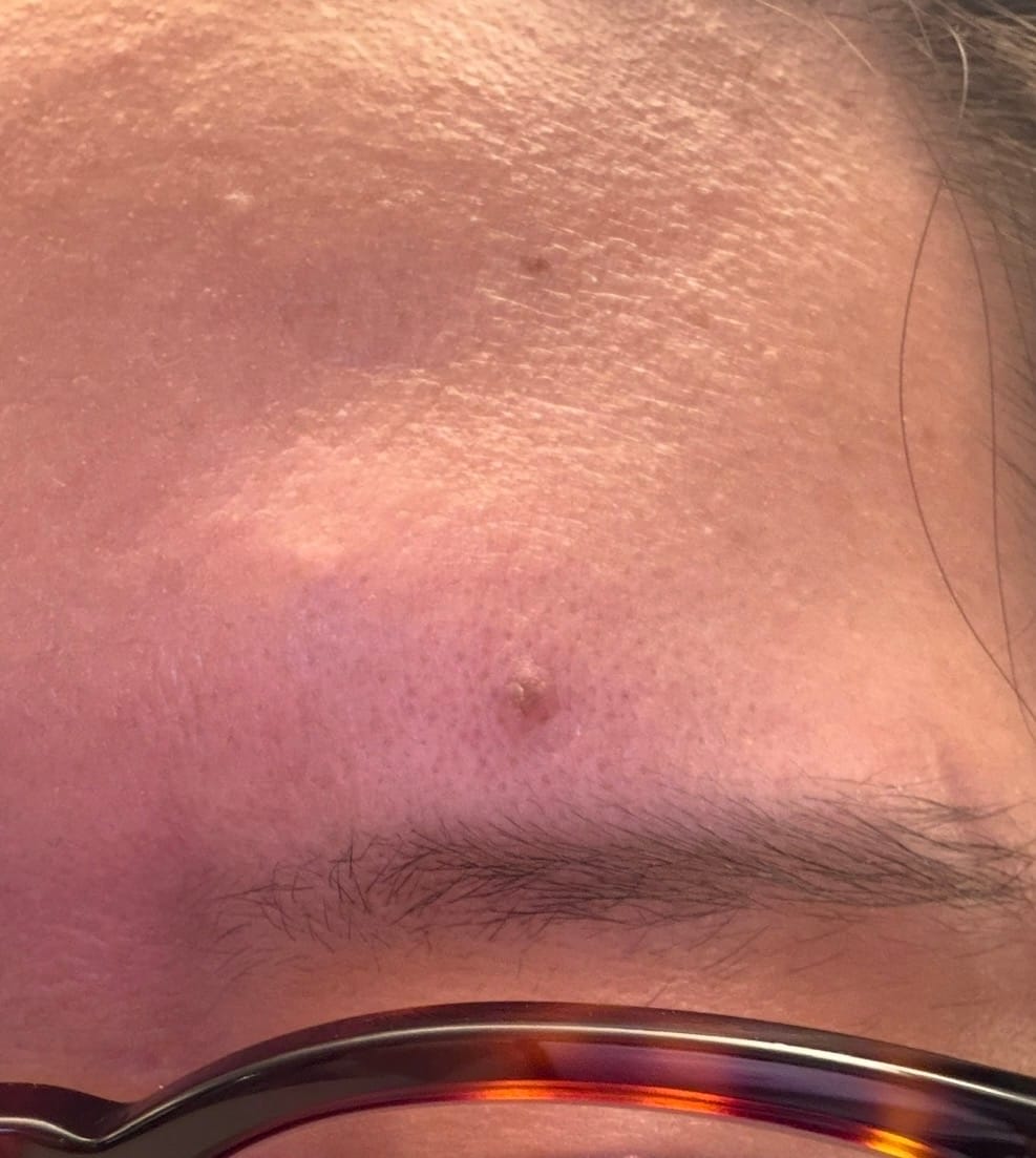 Customer photo review of The Viral Magnesium Super Stick™ — For Skin Tags, Moles, Keratosis & Blemishes