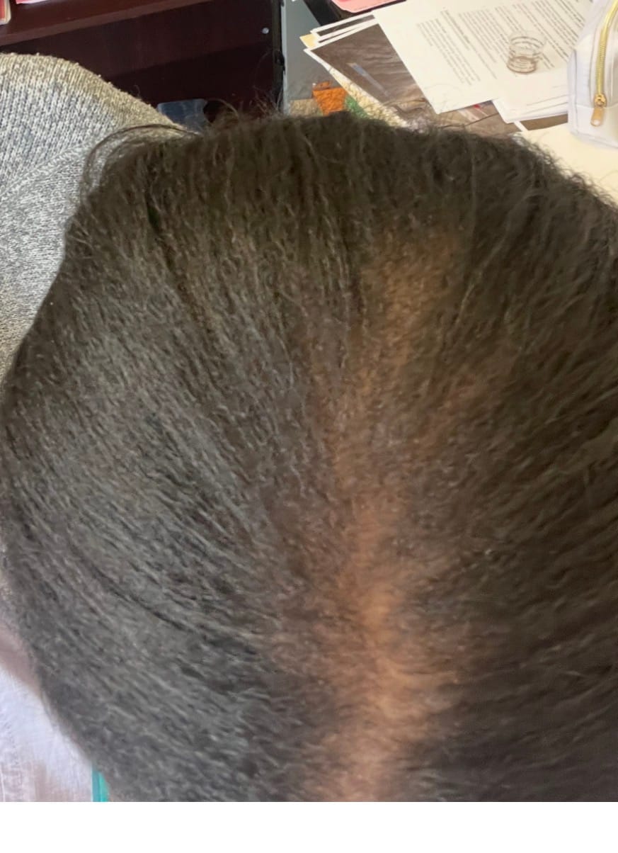 Customer photo review of Gashee Botanical Hair Supplement - Samson