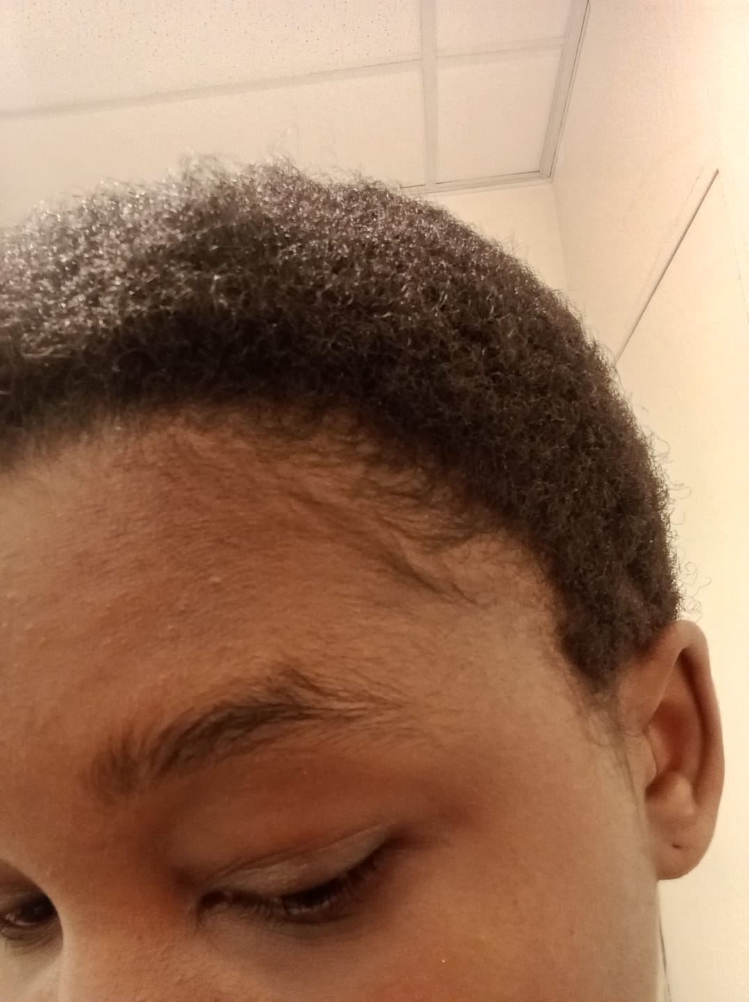 Customer photo review of Minoxidil 5% SOLUTION, 3 x 60ml pack