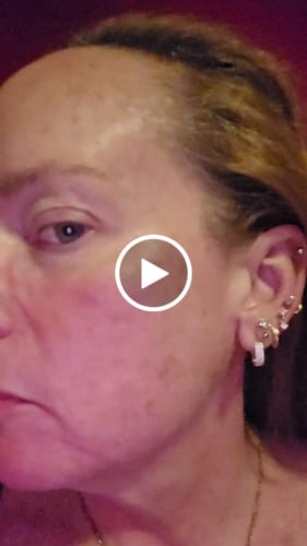 Customer video review of 3 Month Supply - Seranova Micro Infusion System