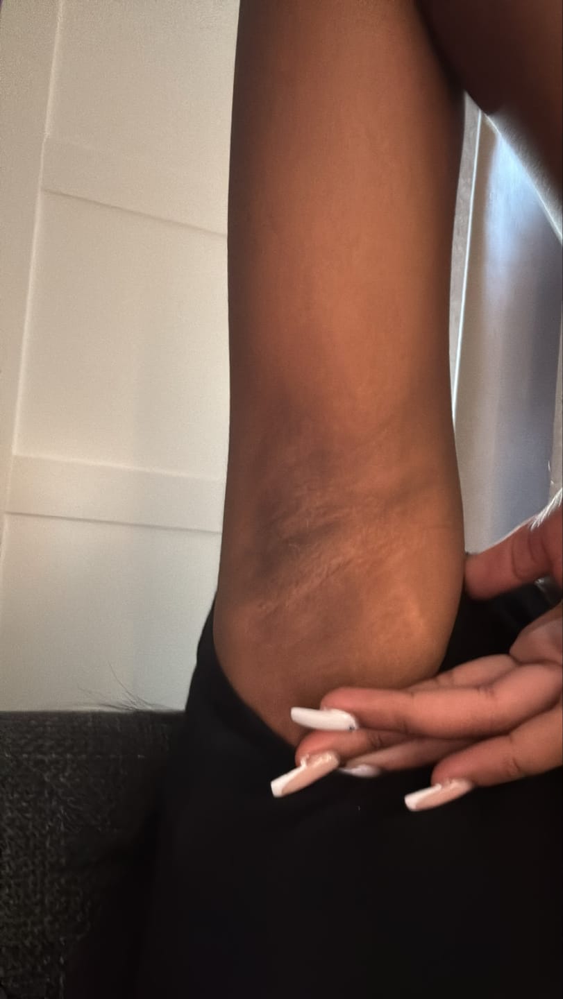 Customer photo review of Spray Exfoliant Anti-Taches Corps · Kojic Acid 99%