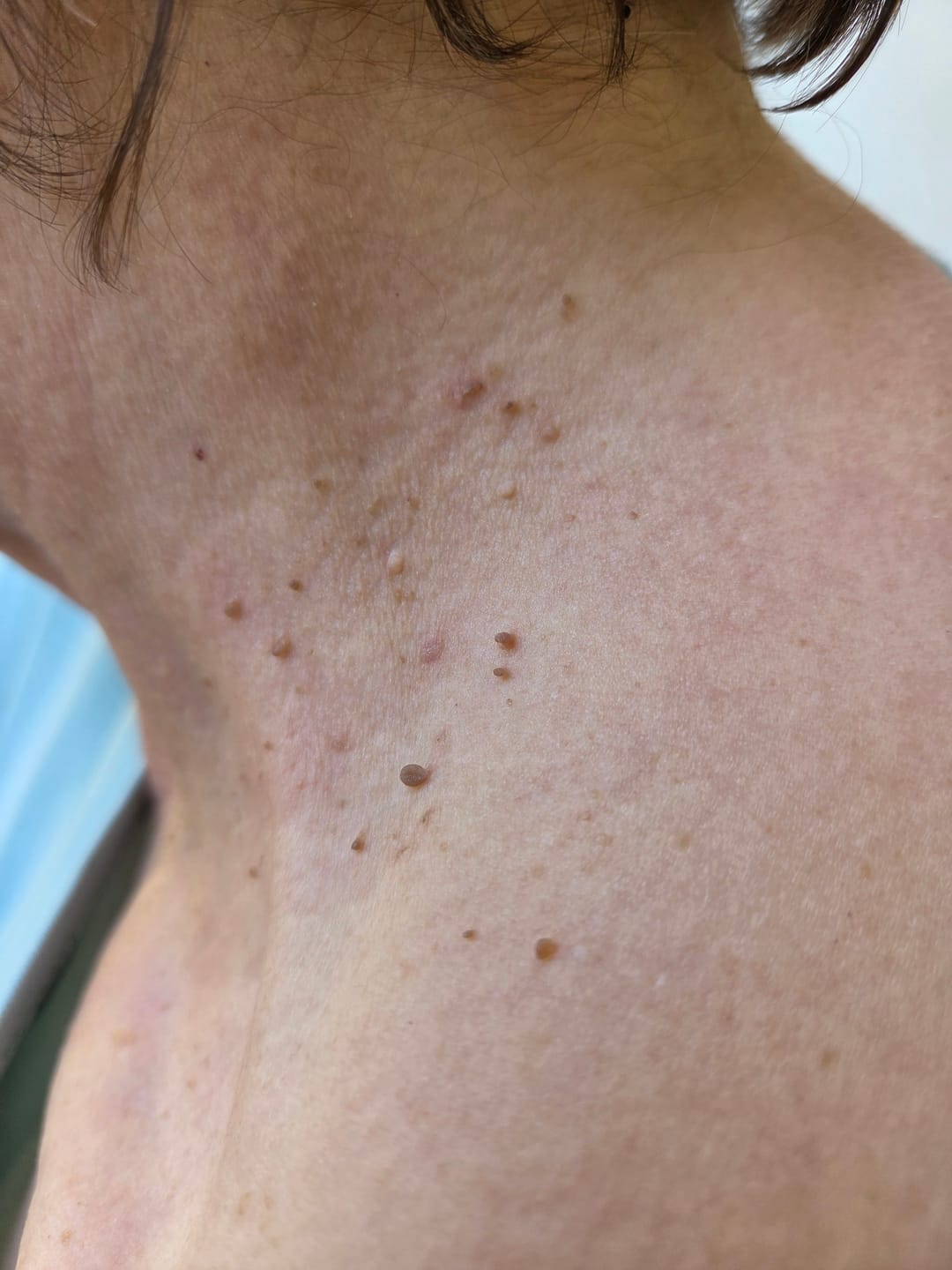 Customer photo review of Alcura Aftercare Patches