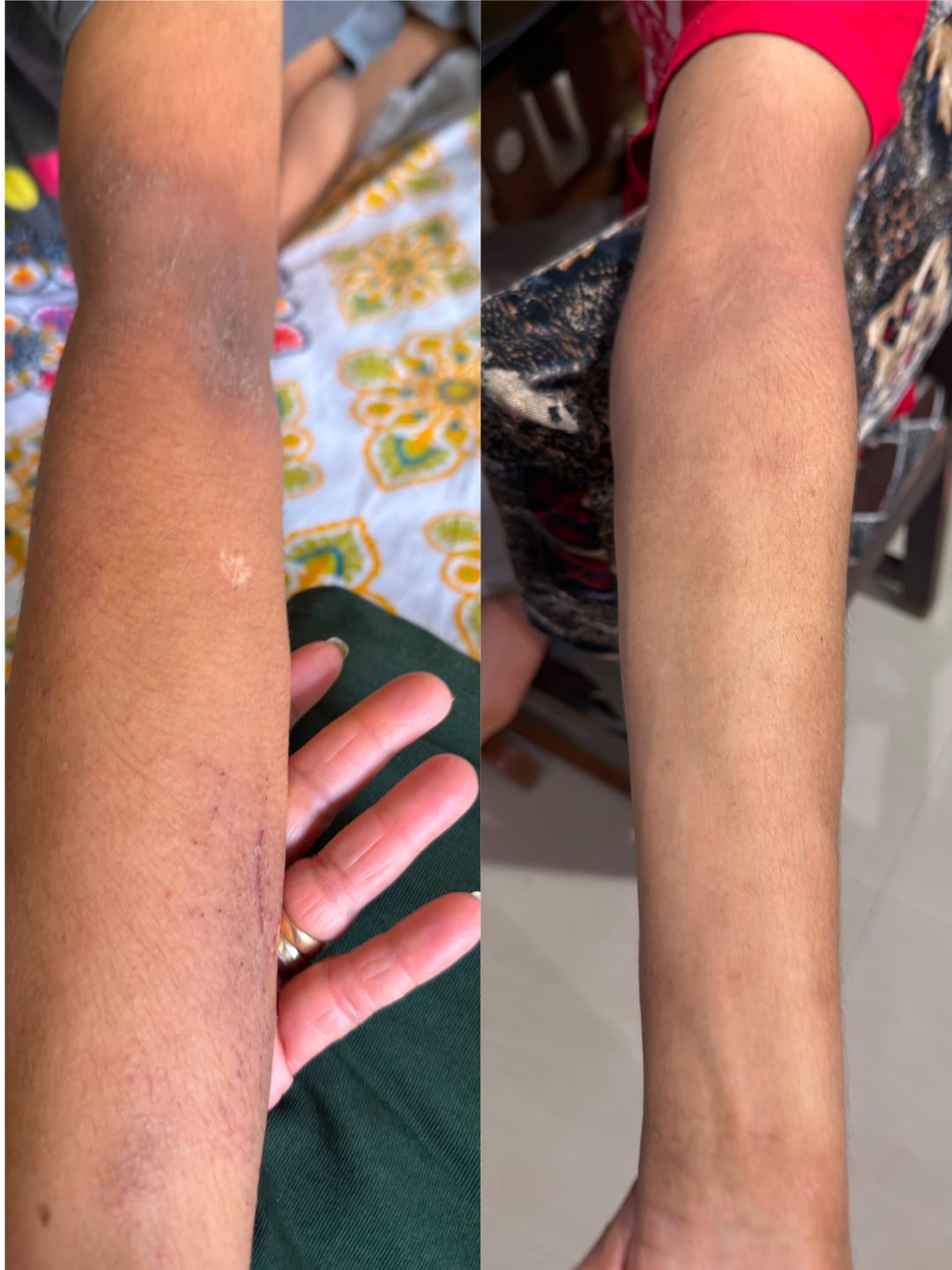 Customer photo review of Eczema Scratch Mitten