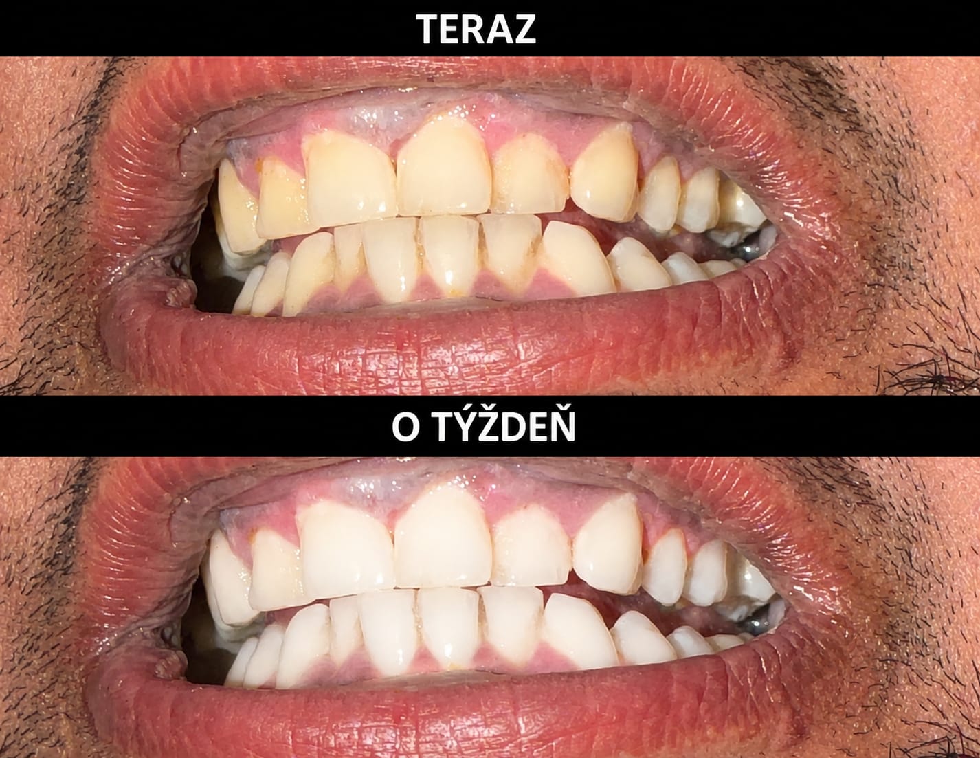 Customer photo review of V34 bieliace pásiky na zuby (14 aplikácií)
