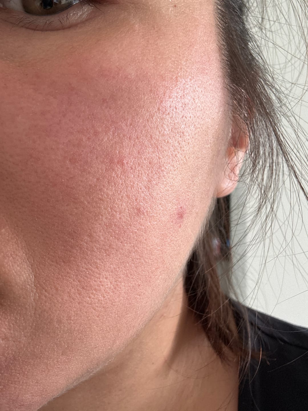 Customer photo review of Rosalique 3 in 1 Anti-Redness Miracle Formula SPF50