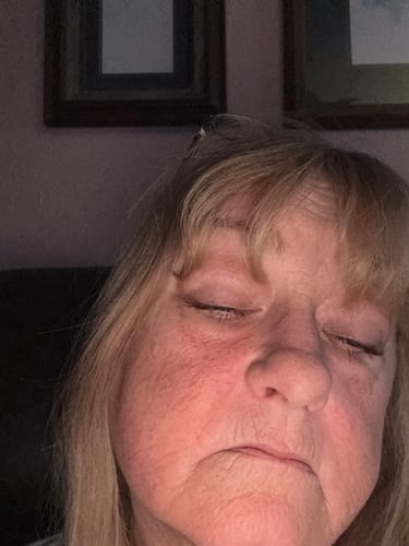 Customer's relaxed face after a treatment with The Micro Infusion System, showing some skin redness.