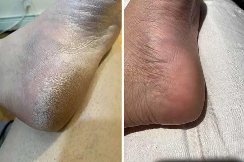 Customer photo review of PediSmooth Pro – Des pieds doux et soignés en quelques gestes