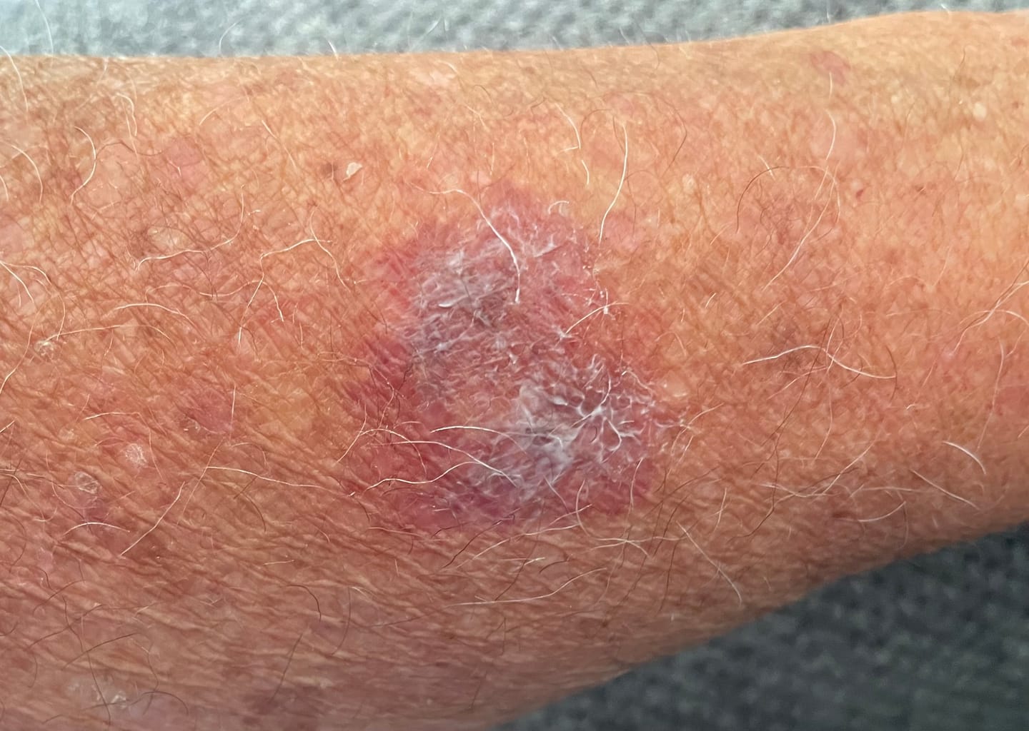 Customer photo review of Arnica Montana + Vitamin K Cream