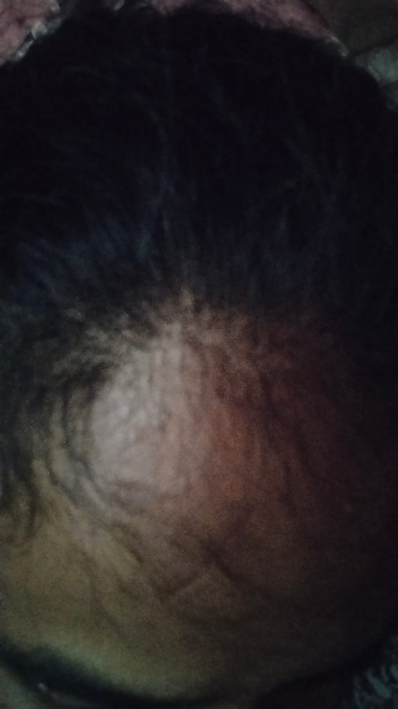 Customer photo review of Advance Hair Growth Serum 2.0 (30ml)