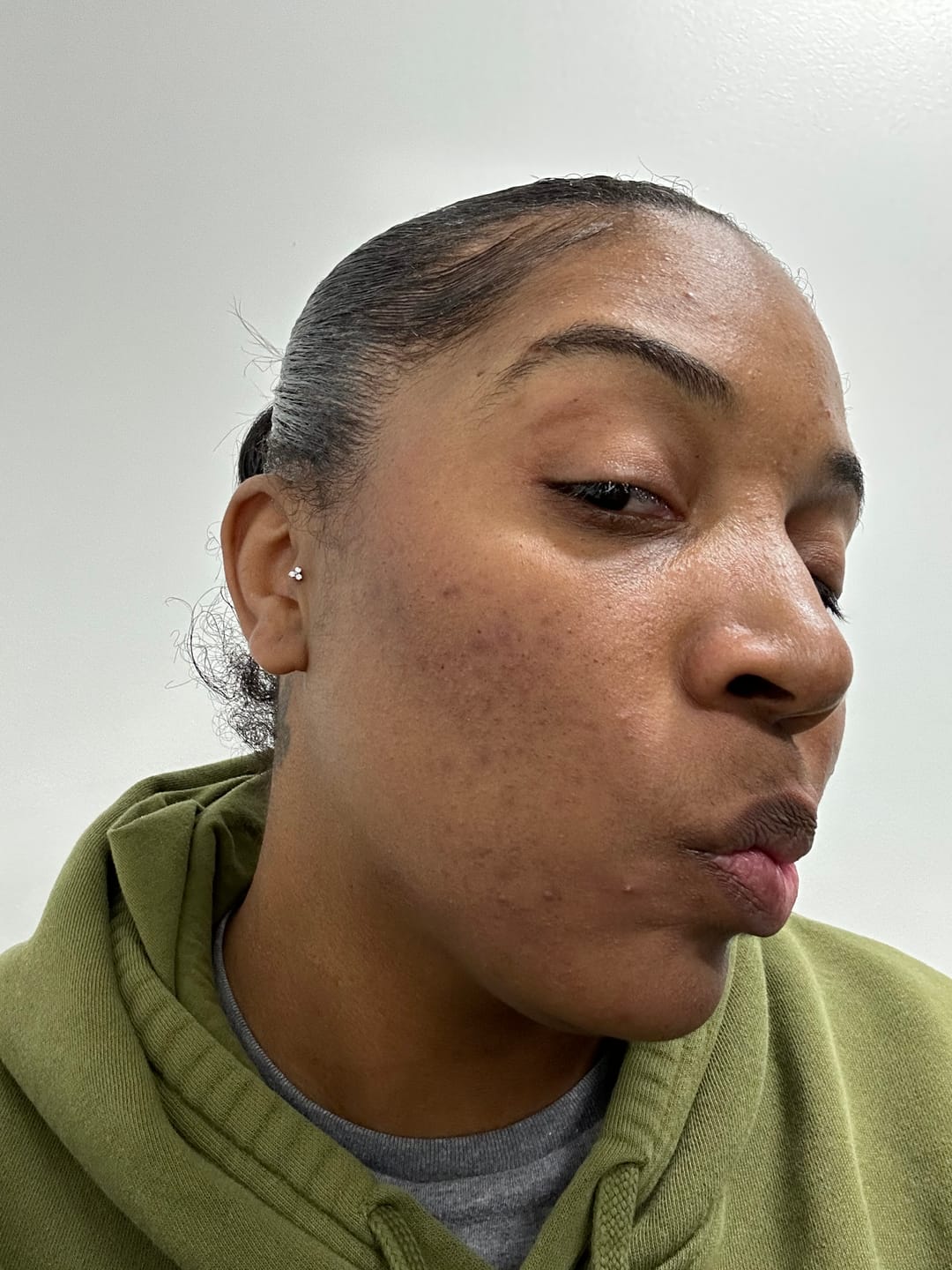 Customer photo review of Anti-Acne & Blemish Bar.