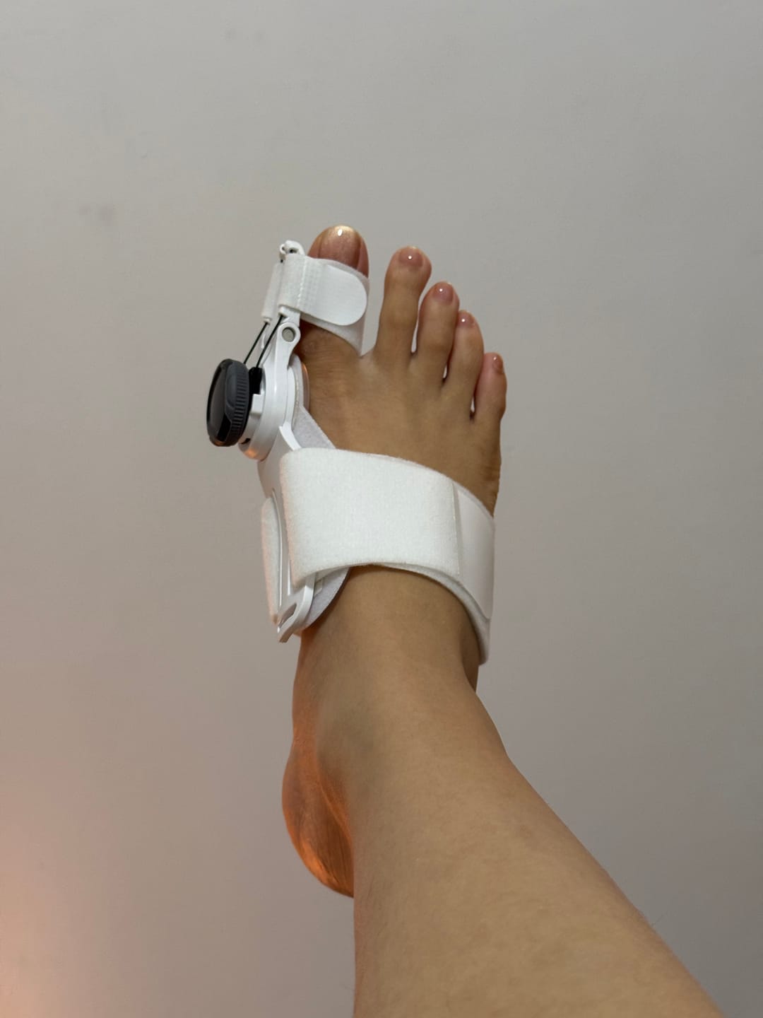 Customer photo review of ToeFix Bunion Corrector