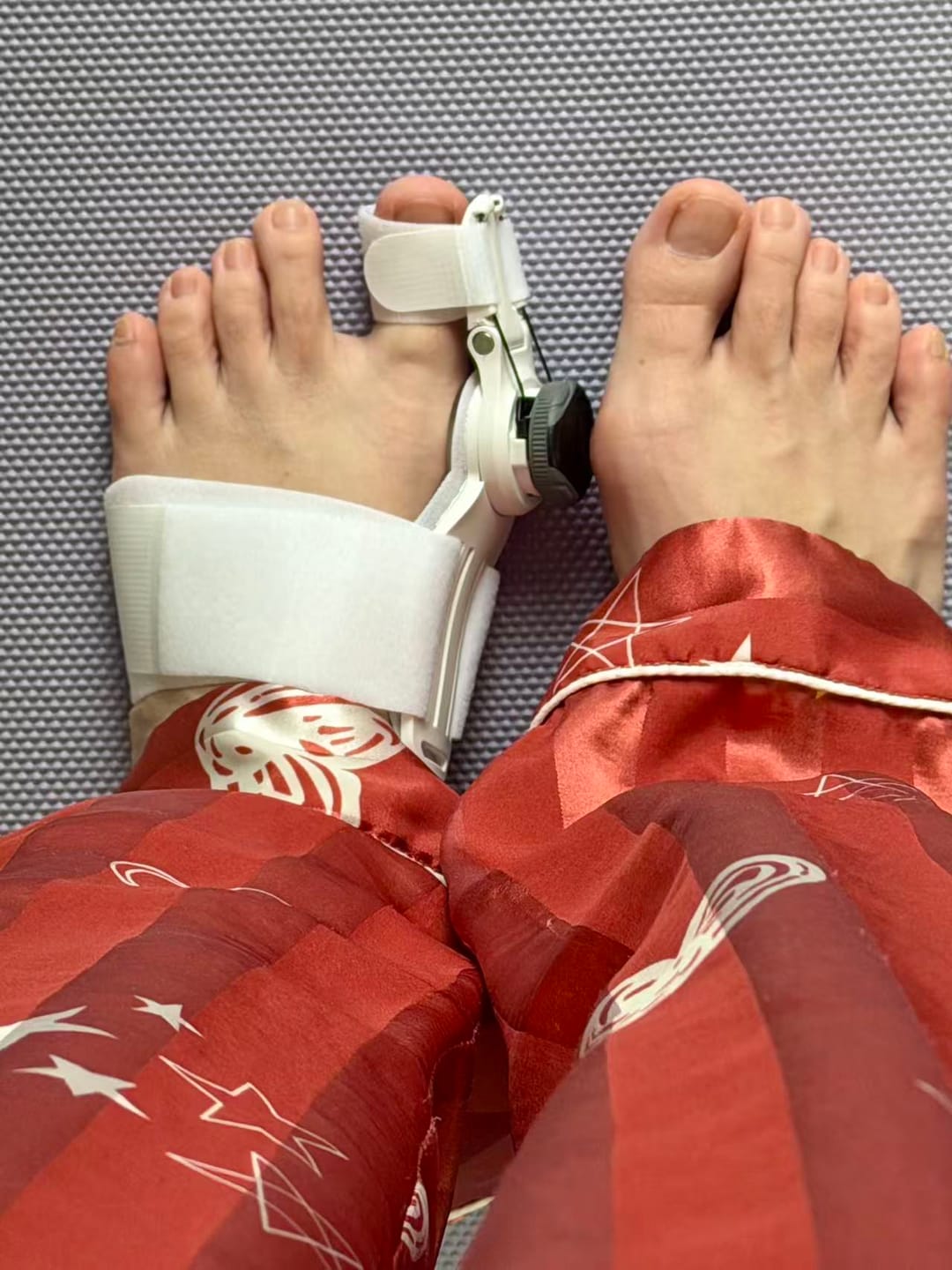 Customer photo review of ToeFix Bunion Corrector