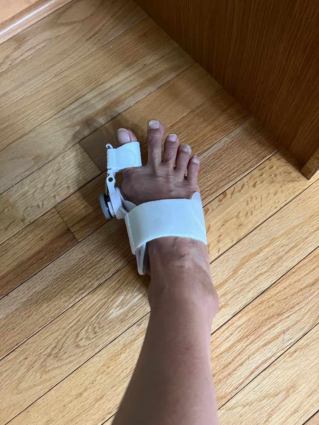 Customer photo review of ToeFix Bunion Corrector