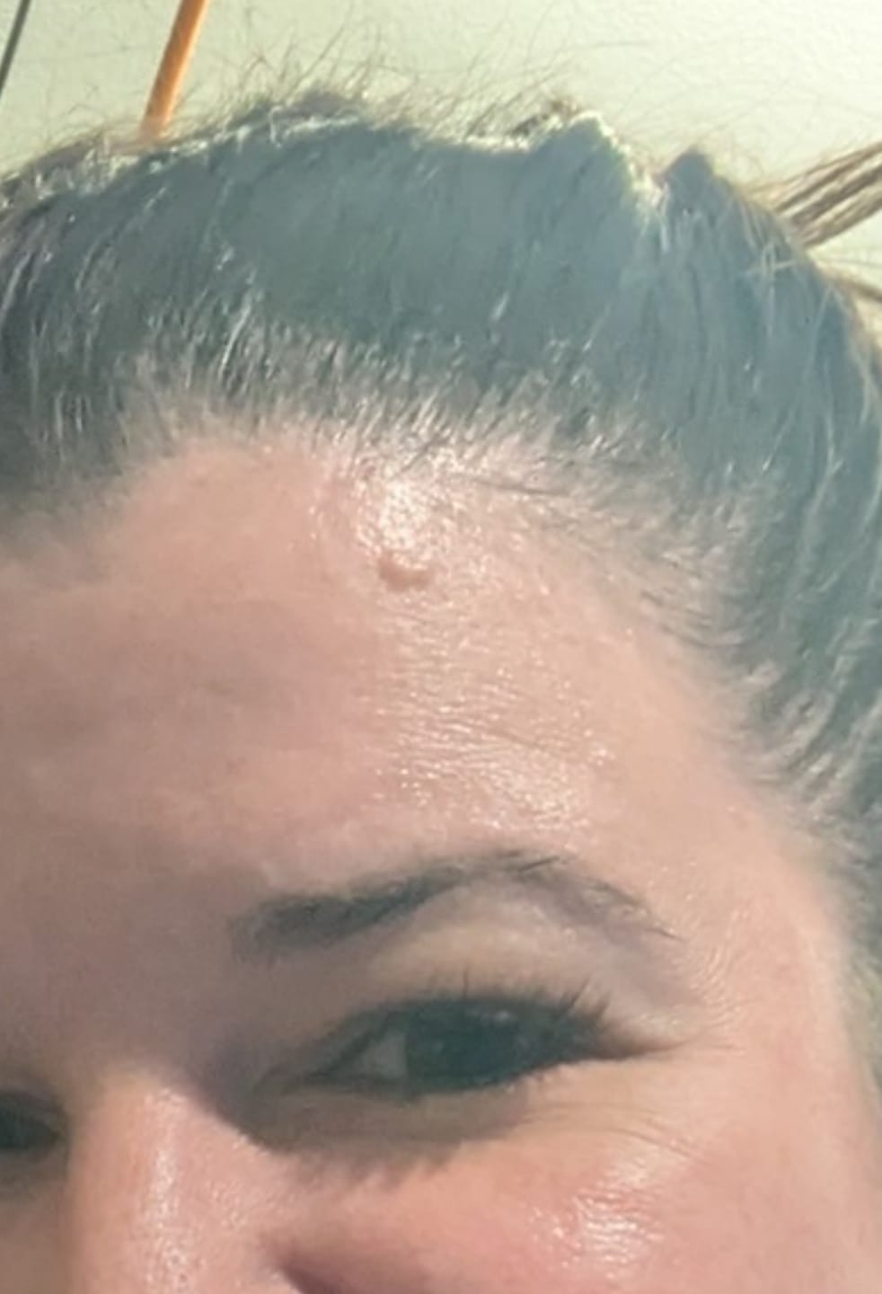 Customer photo review of The Viral Magnesium Super Stick™ — For Skin Tags, Moles, Keratosis & Blemishes