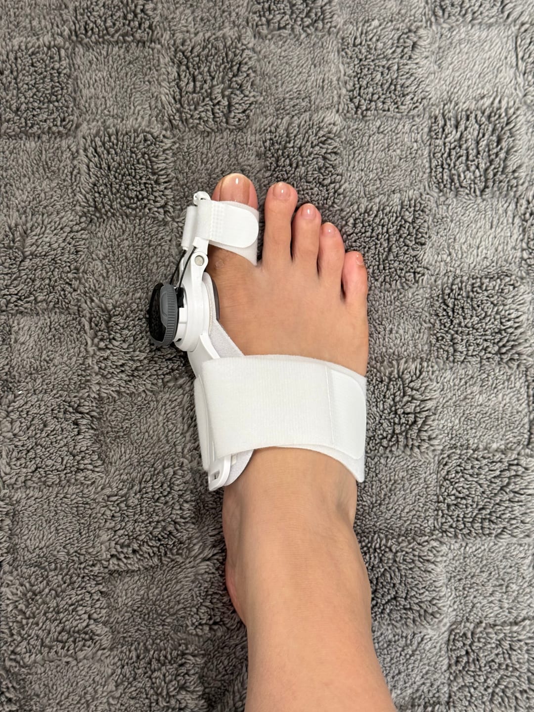 Customer photo review of ToeFix Bunion Corrector