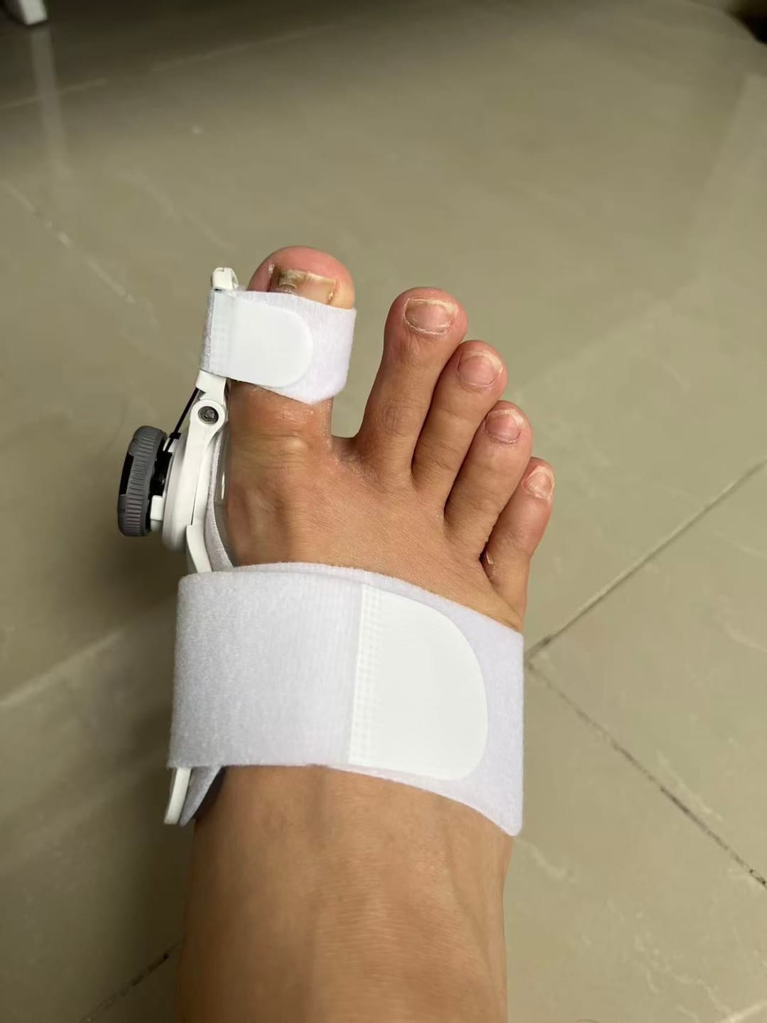 Customer photo review of ToeFix Bunion Corrector