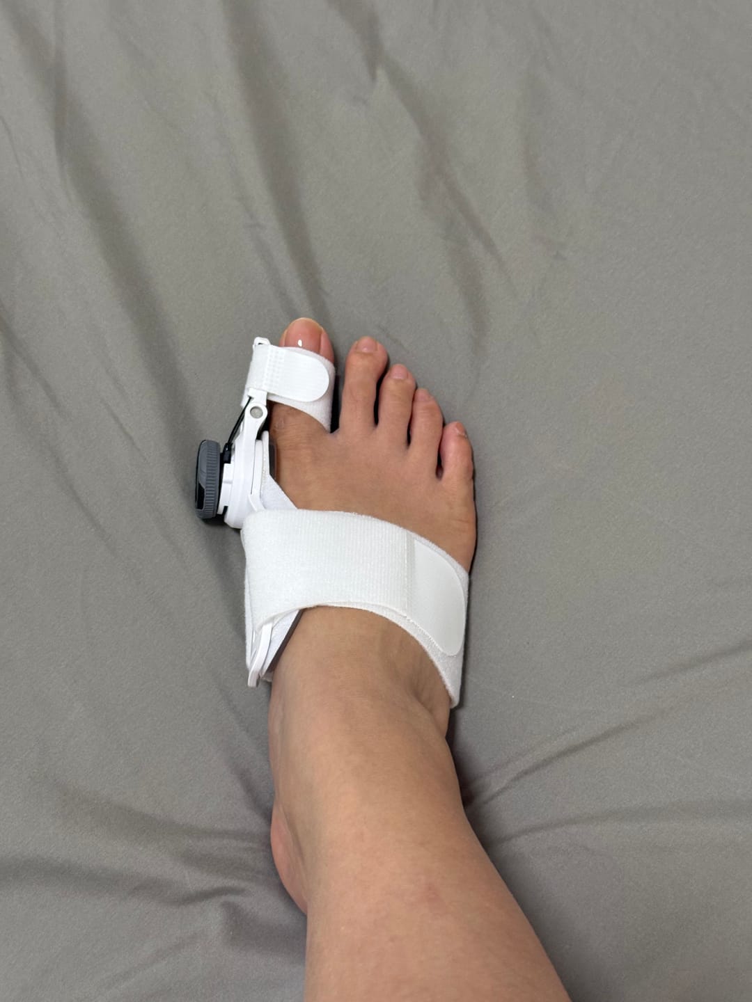 Customer photo review of ToeFix Bunion Corrector