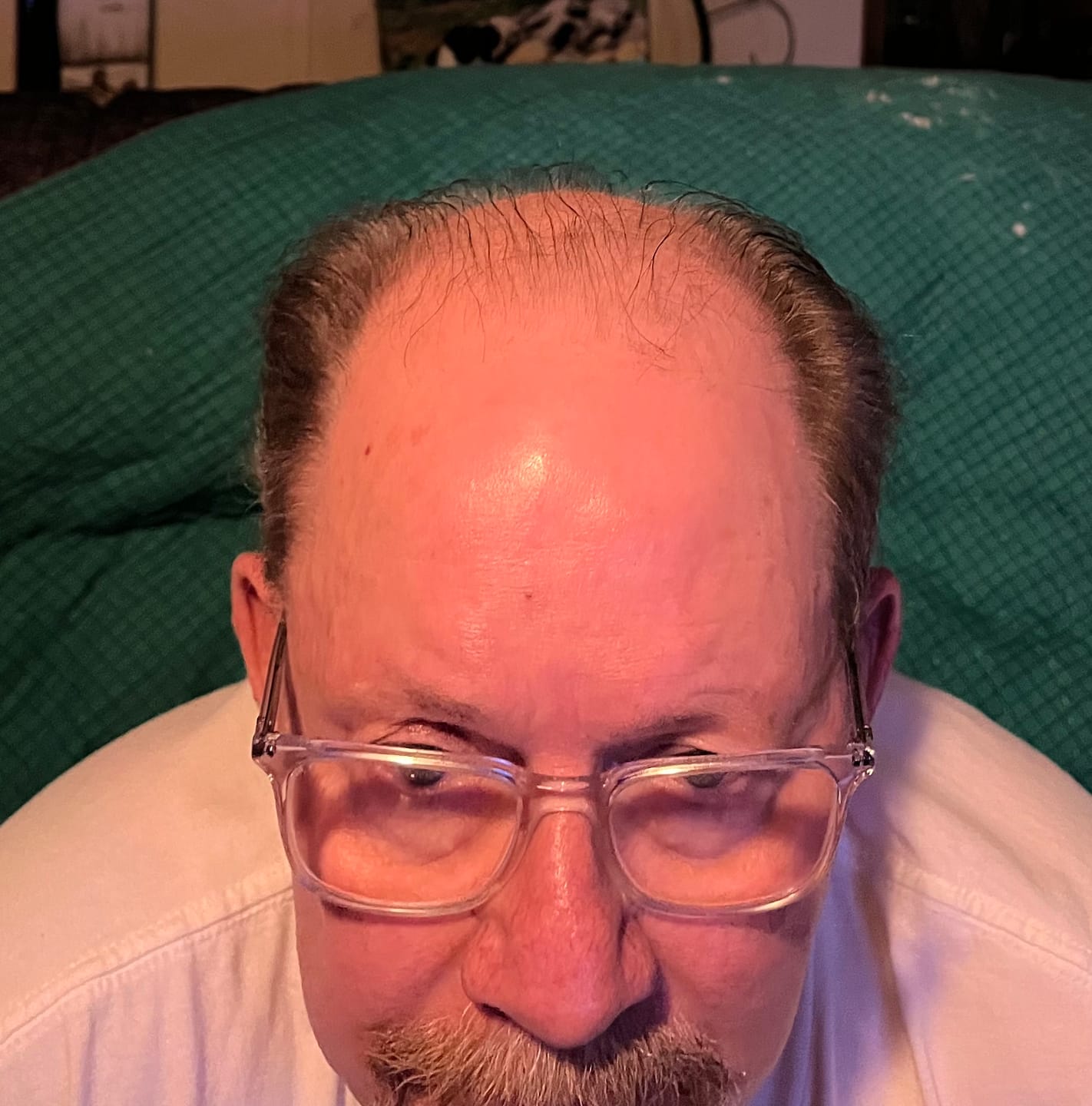 Customer photo review of Micro Infusion System ck-s3m