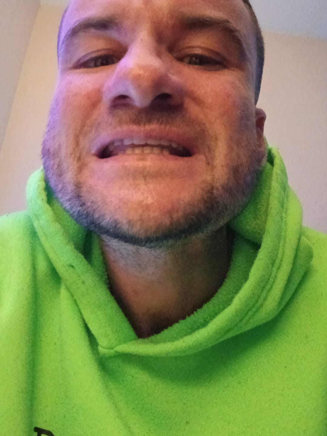 Customer photo review of Flexible Partial Denture