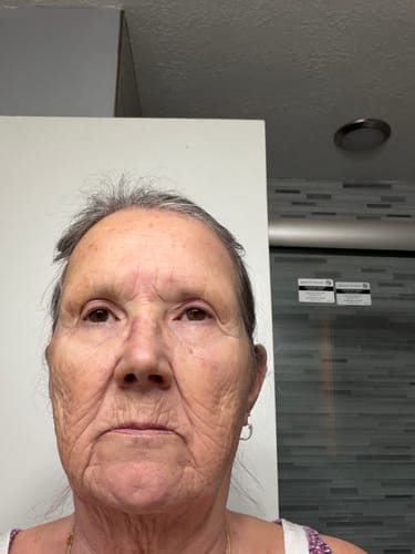 Reviewer showing their facial skin condition before seeing results from The Micro Infusion System.