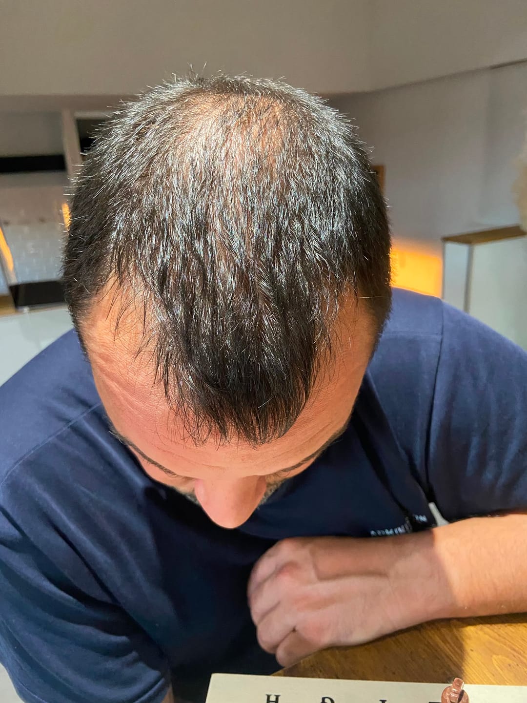 Customer photo review of SÉRUM CAPILLAIRE MULTI ACTIF BIO-DENSYL®
