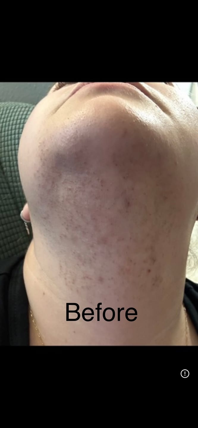 Customer photo review of Hair Reducing Fade Oil - Slows Growth, Thins, and Reduces Hair Naturally