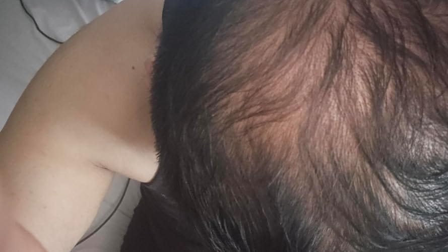 Customer photo review of Pepcobrix Sistema para el Crecimiento del Cabello