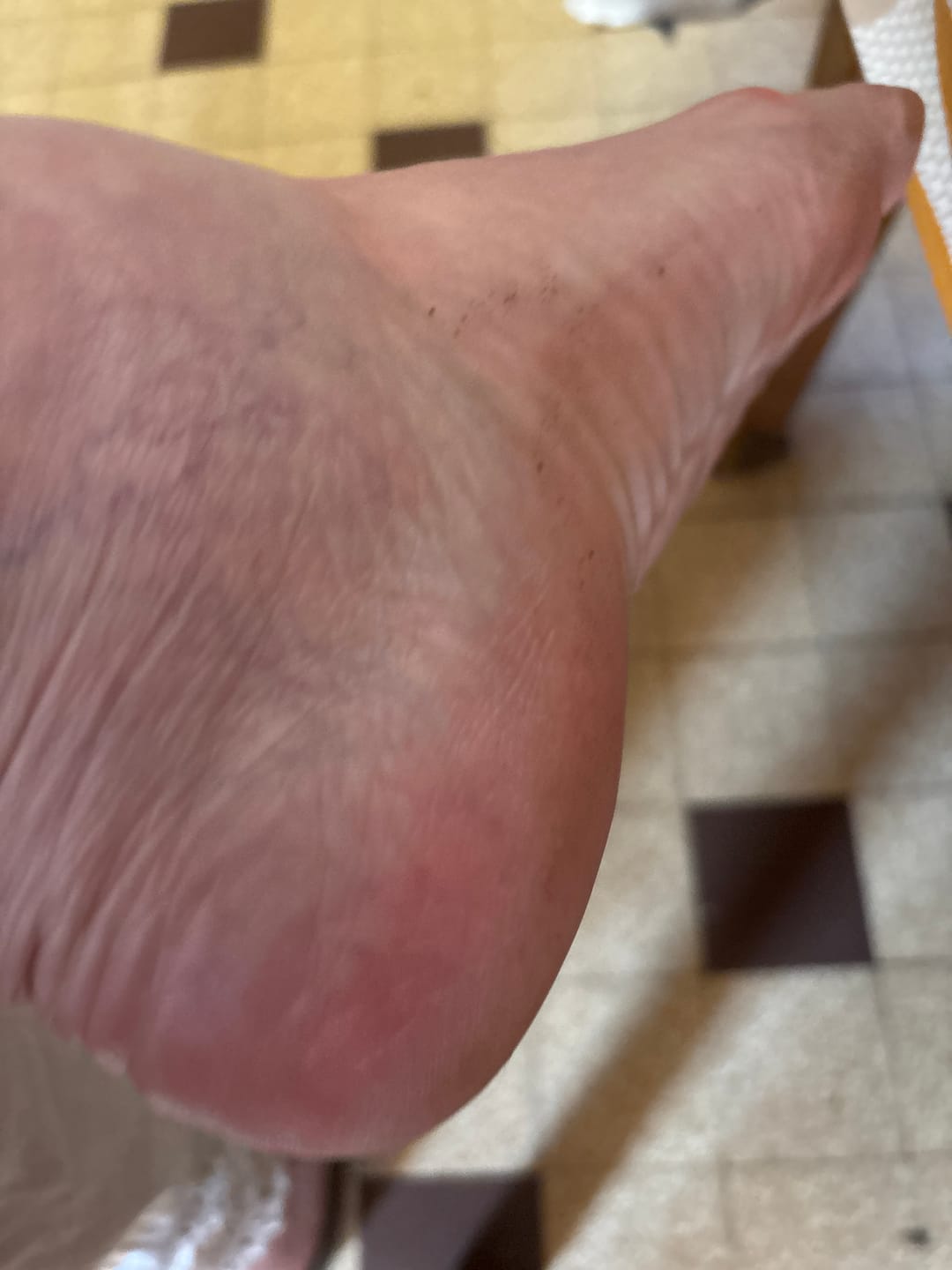 Customer photo review of LOVASKIN INSTANT FOOT PEEL Essential Kit - Great value, 25 uses in one bottle