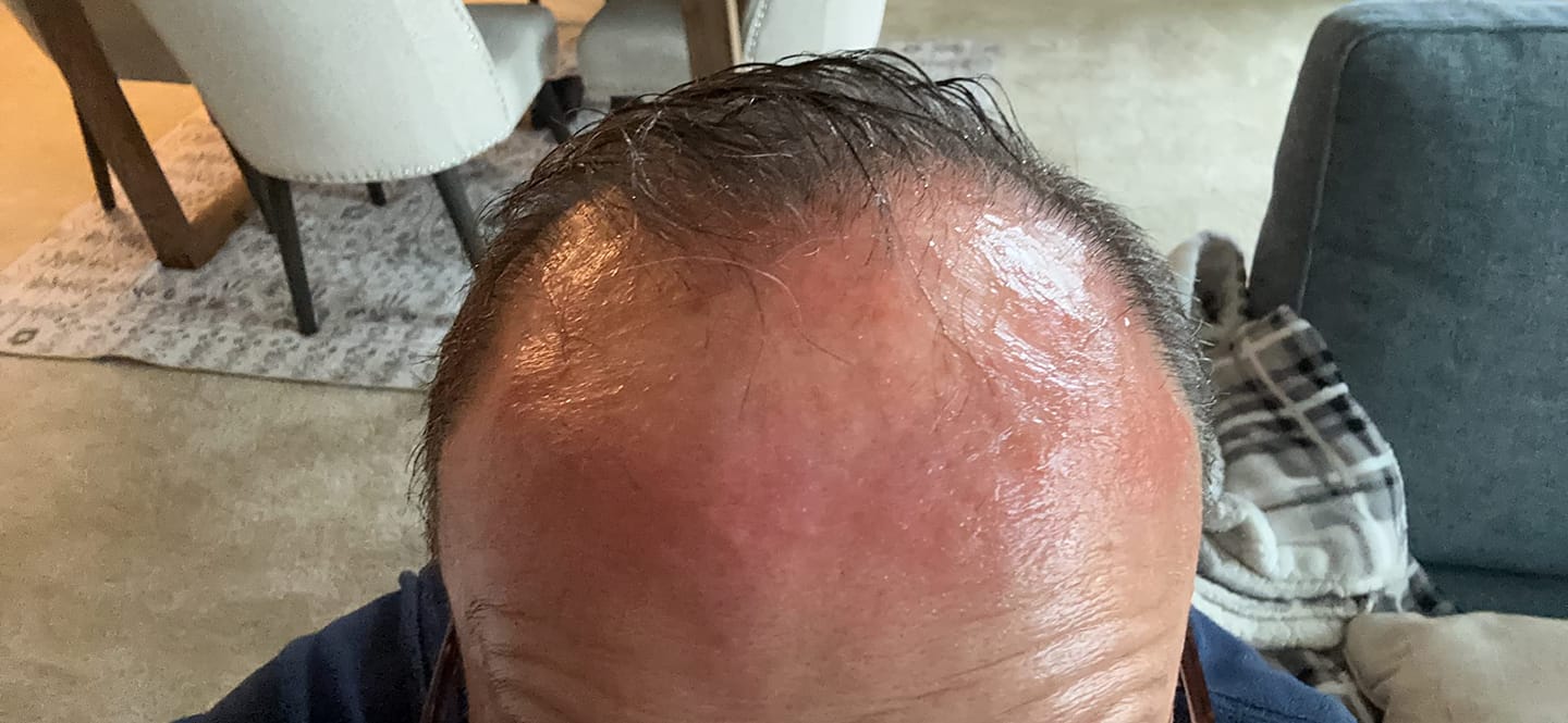 Customer photo review of Pepcobrix Sistema para el Crecimiento del Cabello