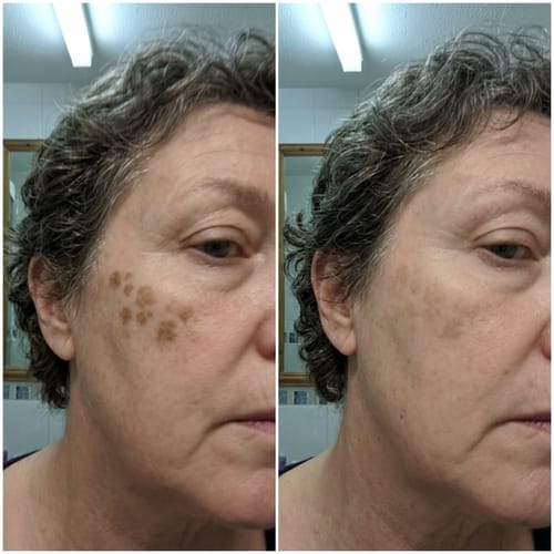 Customer photo review of Alpha-Arbutin + Vitamin C Brightening Bar