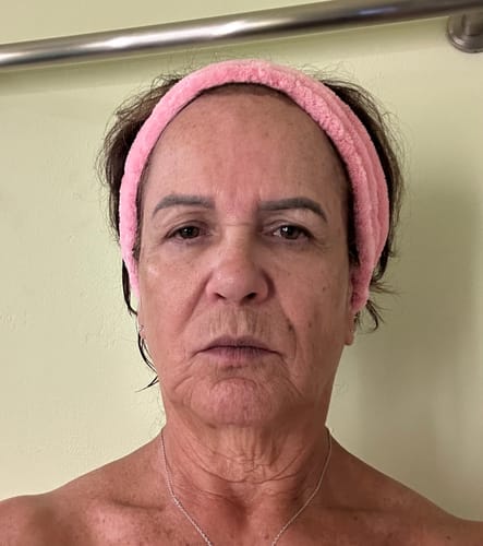 Reviewer's face wearing a pink headband after using the Seranova Micro Infusion System.