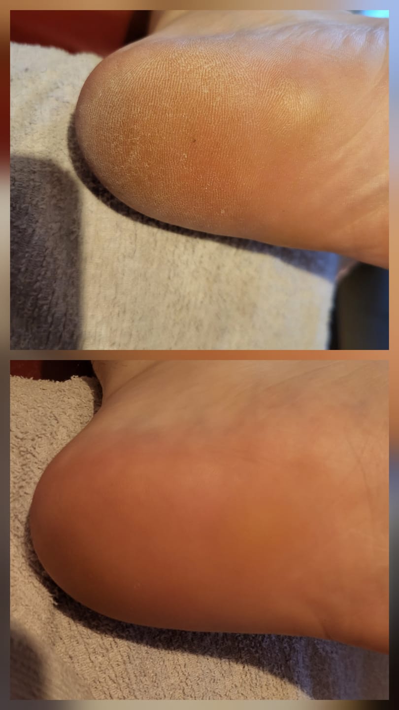 Customer photo review of LOVASKIN INSTANT FOOT PEEL Essential Kit - Great value, 25 uses in one bottle