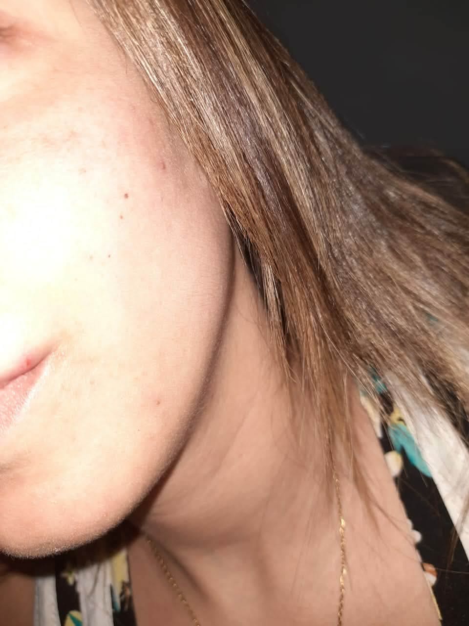 Customer photo review of Niacinamide 12% – ULTRA PURE · HIGH POTENCY