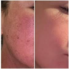 Customer photo review of Alpha-Arbutin + Vitamin C Brightening Bar