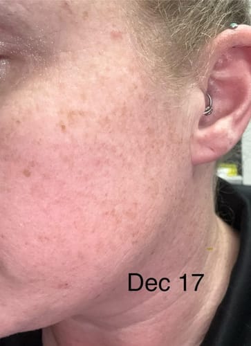 Customer photo review of Alpha-Arbutin + Vitamin C Brightening Bar