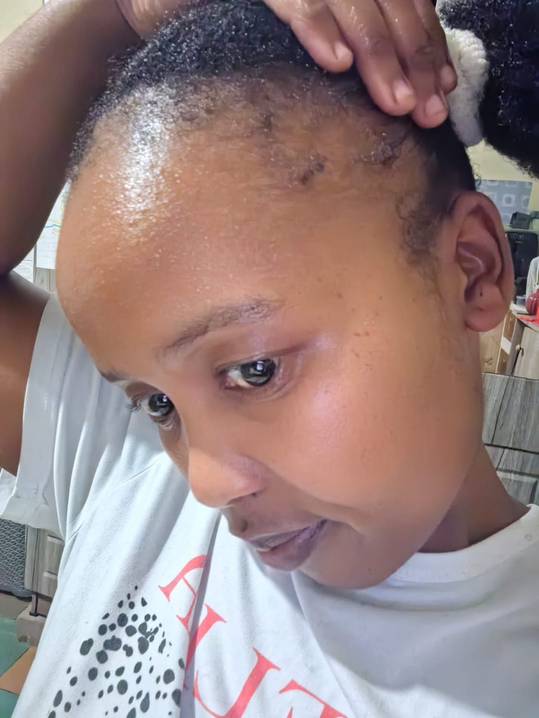Customer photo review of Minoxidil 5% SOLUTION, 3 x 60ml pack
