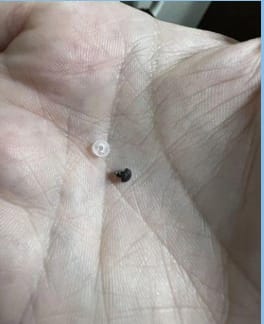 Customer photo review of Painless Skin Tag Removal Kit