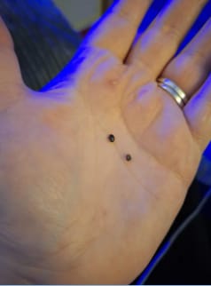 Customer photo review of Painless Skin Tag Removal Kit